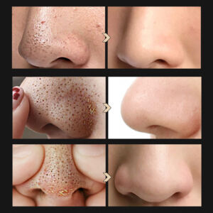 Blackhead Cleansing Kit – Nose Strip and Pore Care Set